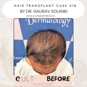 Hair Transplant Case 418 - Before Treatment at Cult Aesthetics Gurgaon