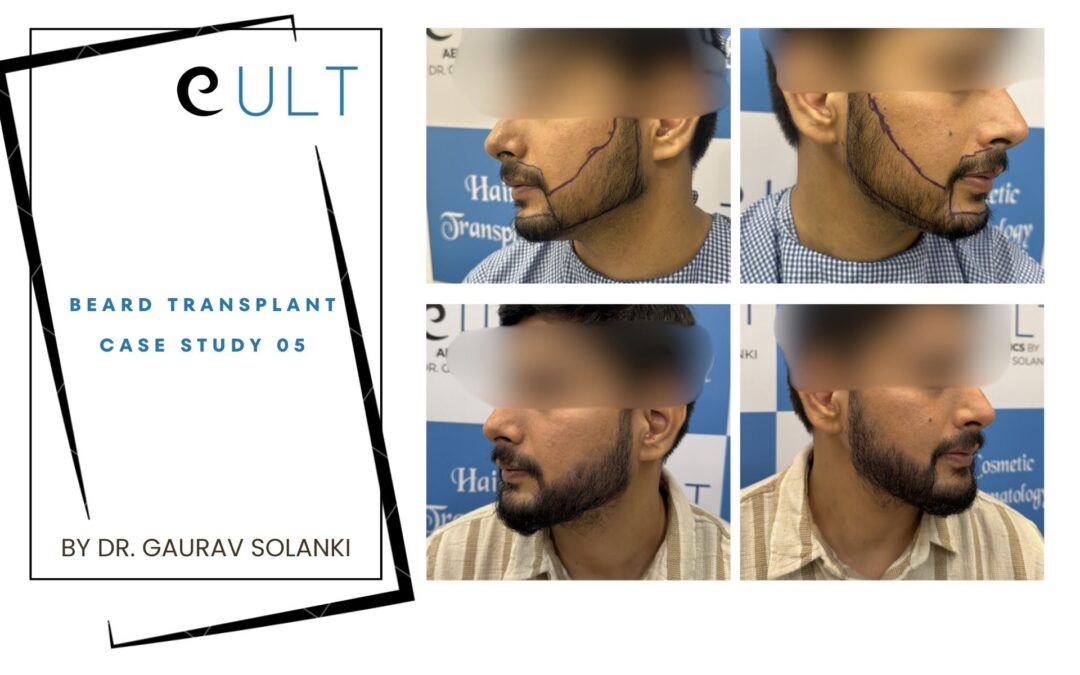 Beard Transplant Case 05