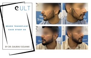 Beard Transplant case 05