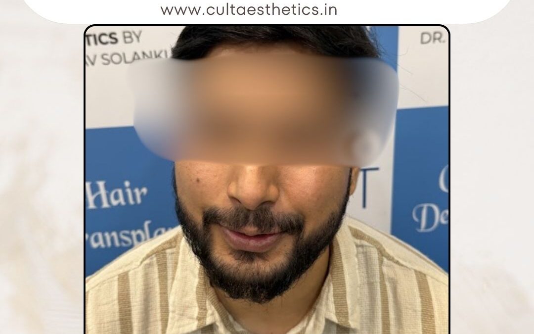 Beard Case 05 After 3