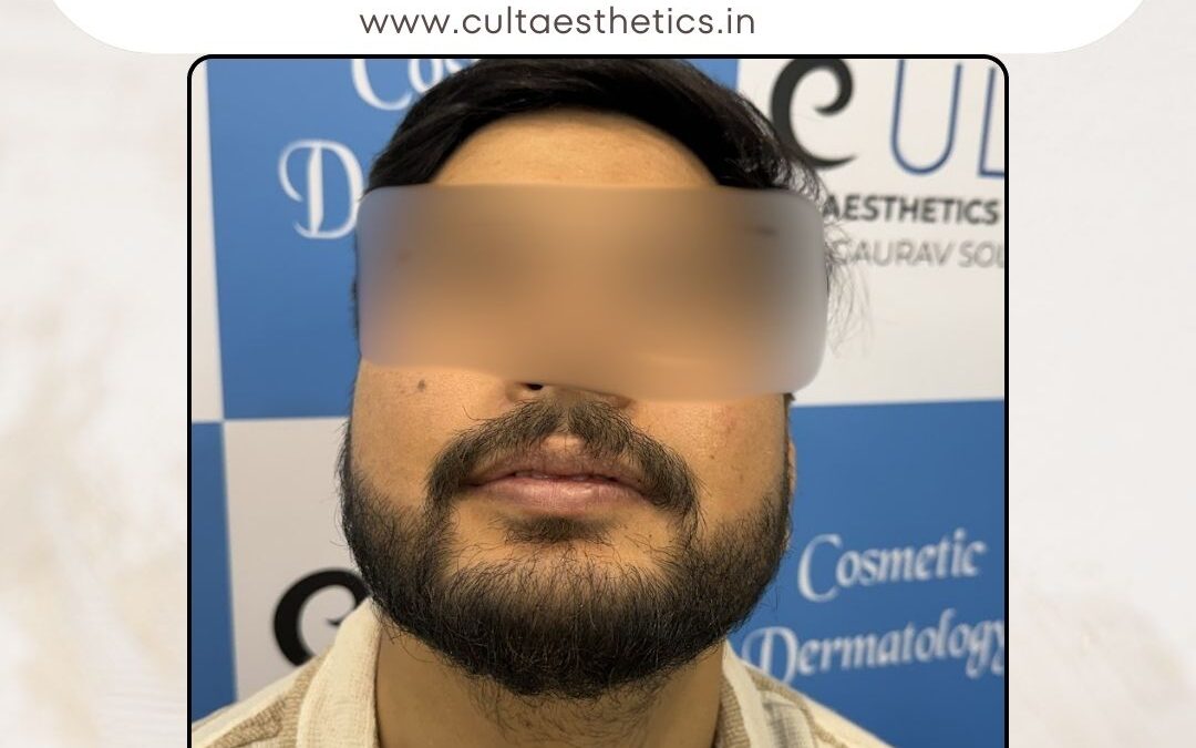 Beard Case 05 After 4