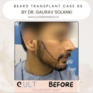 Beard case 05 Before-1