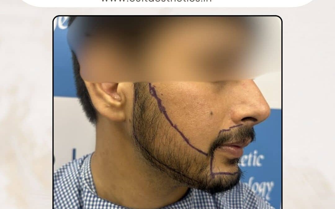 Beard Case 05 Before 2