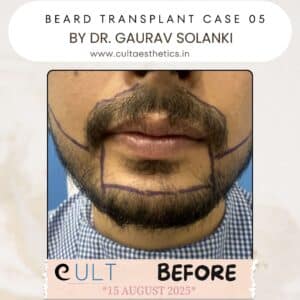 Beard case 05 Before-3