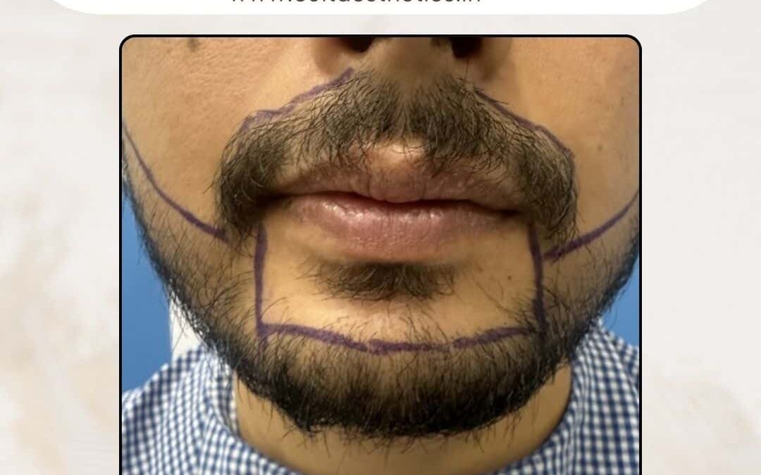 Beard Case 05 Before 3