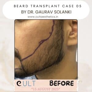 Beard case 05 Before-4