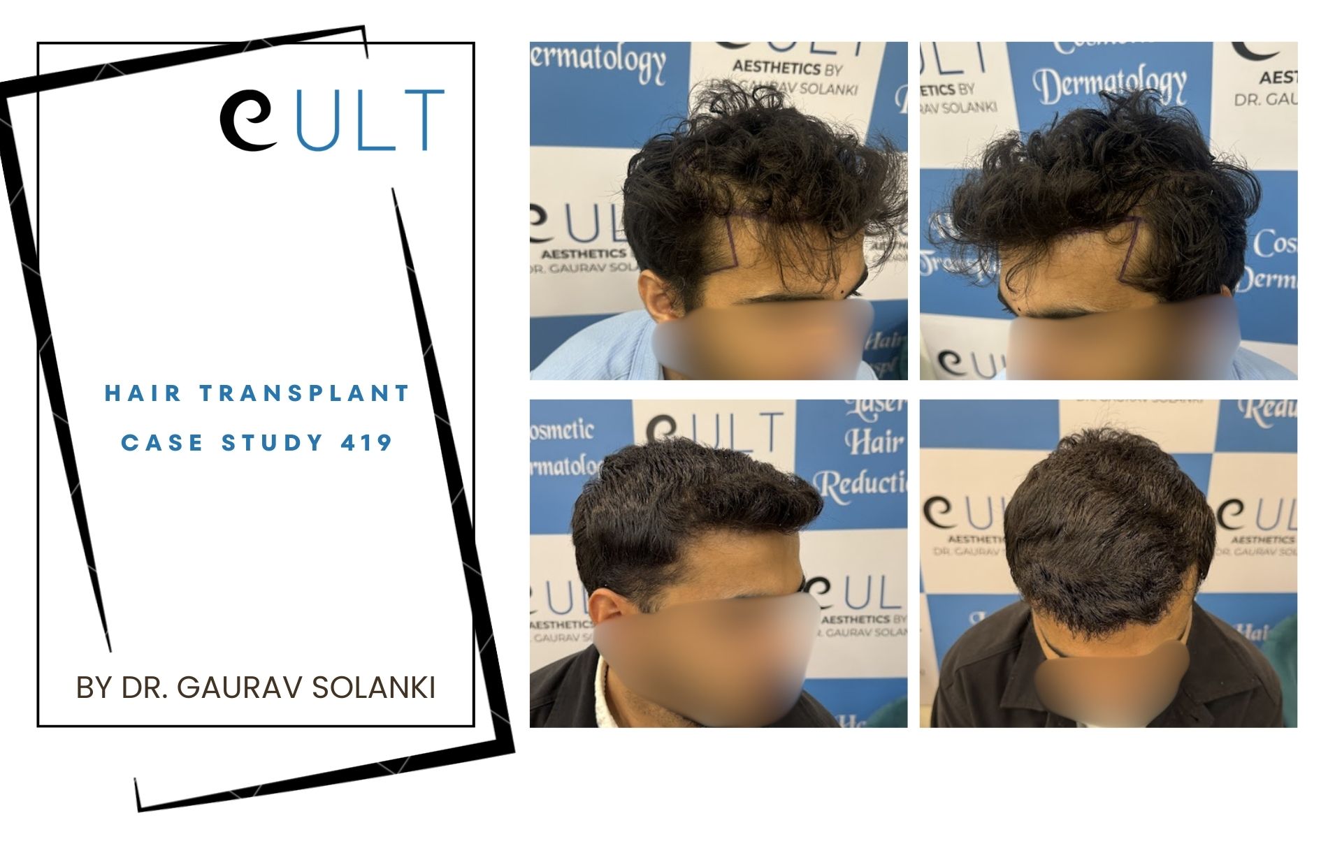 Hair Transplant case 419