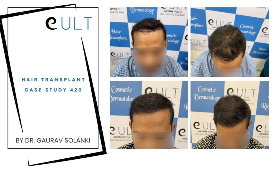 Hair Transplant Case 420
