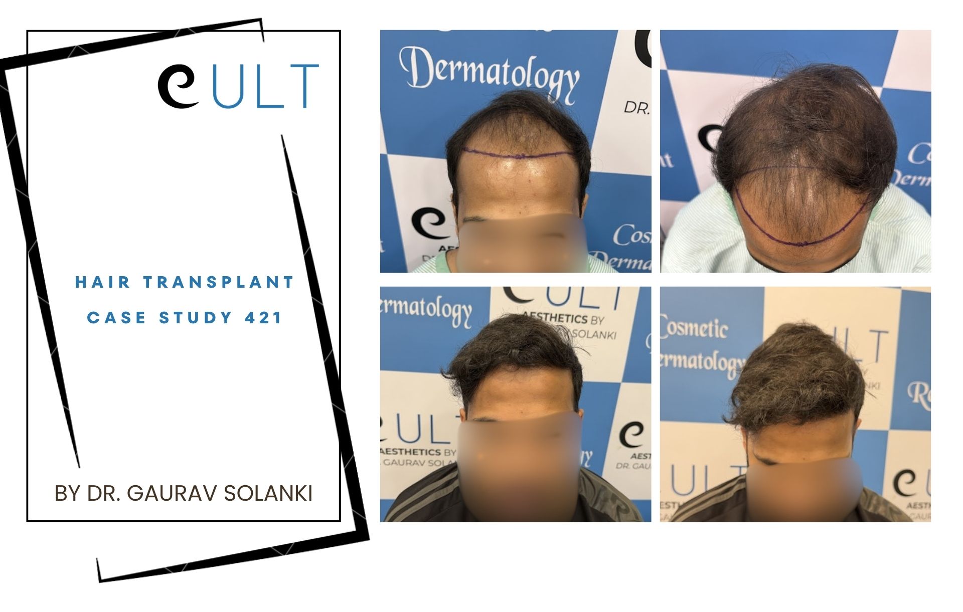 Hair Transplant case 421