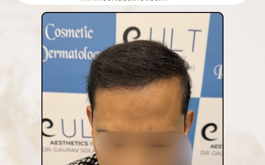 Hair Case 420 After 1