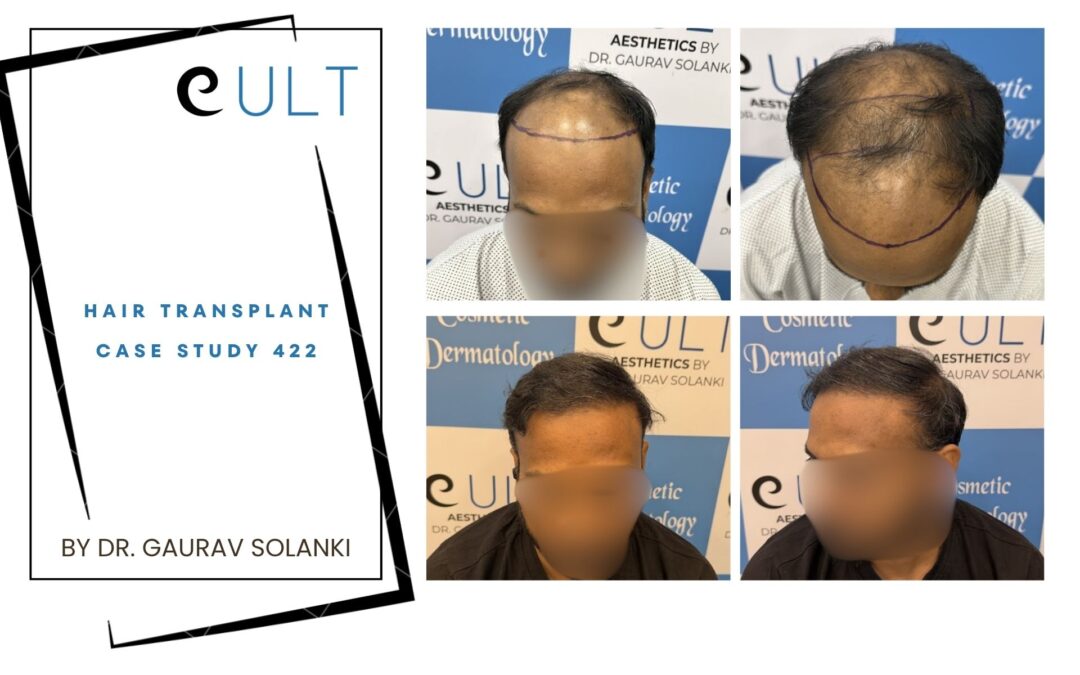Hair Transplant Case 422