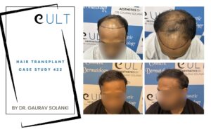 Hair Transplant Case 422 Results - Cult Aesthetics Gurgaon