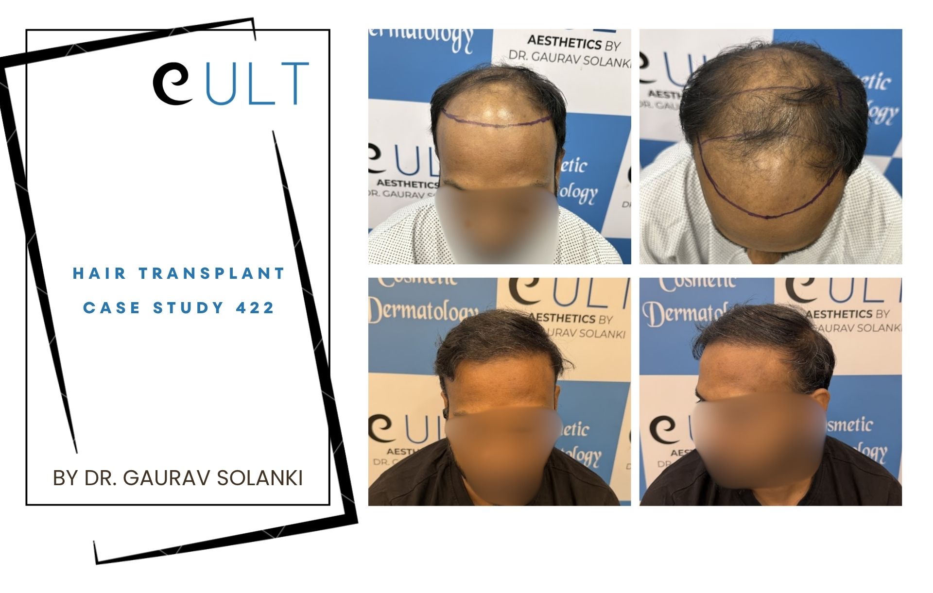 Hair Transplant case 422 Hair Transplant case 420