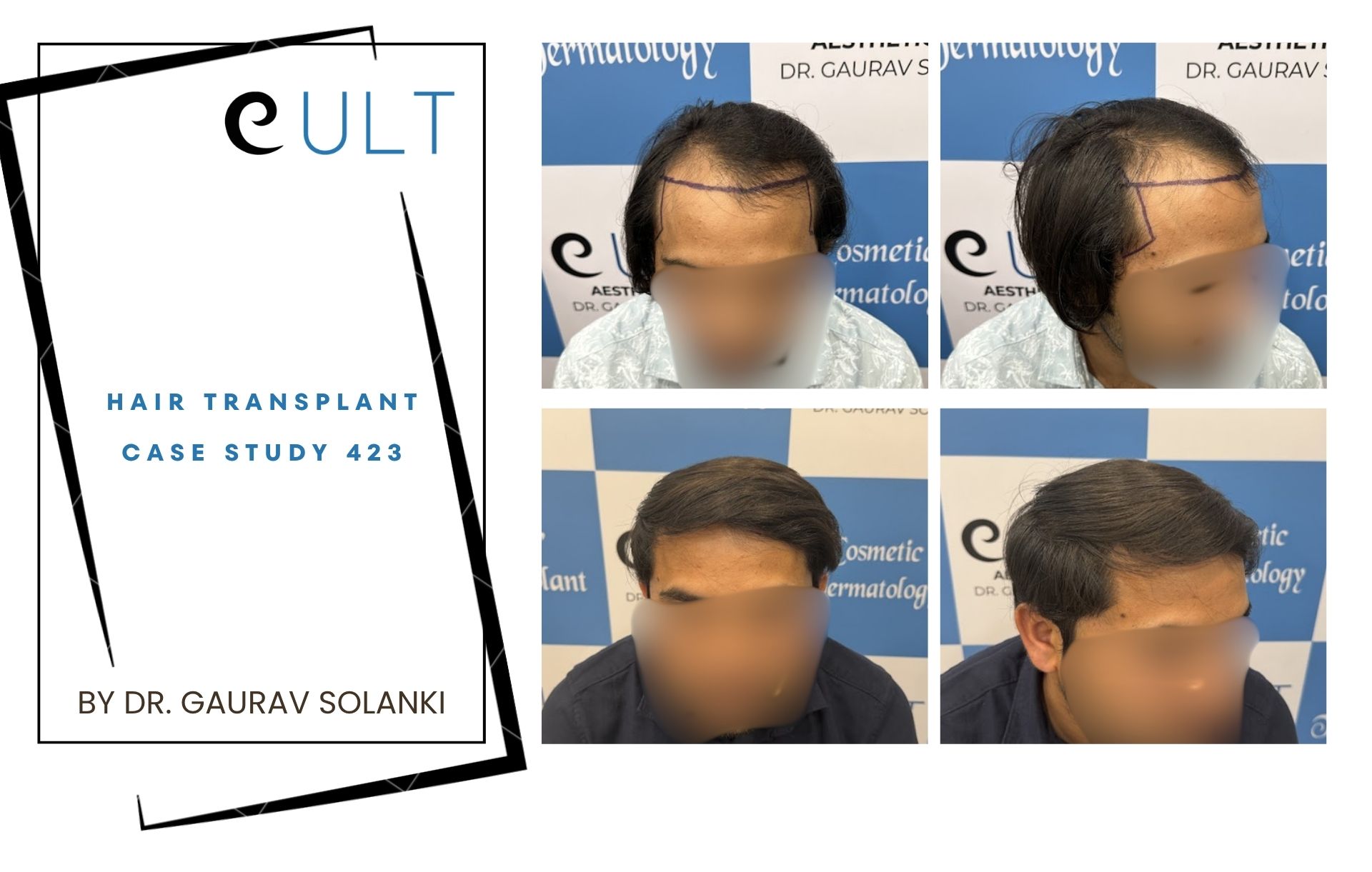 Hair Transplant case 423 Hair Transplant case 421