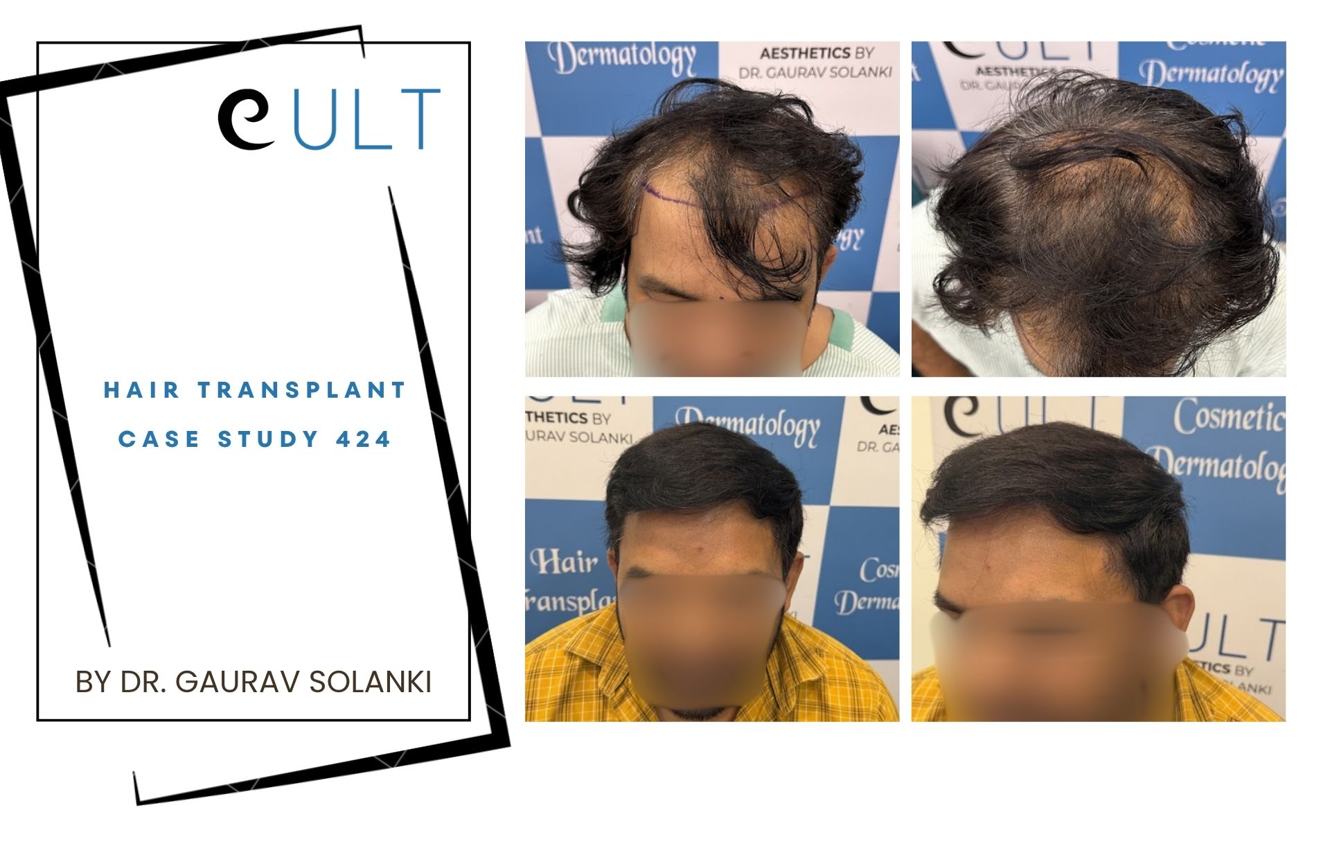 Hair Transplant case 424 Hair Transplant case 420