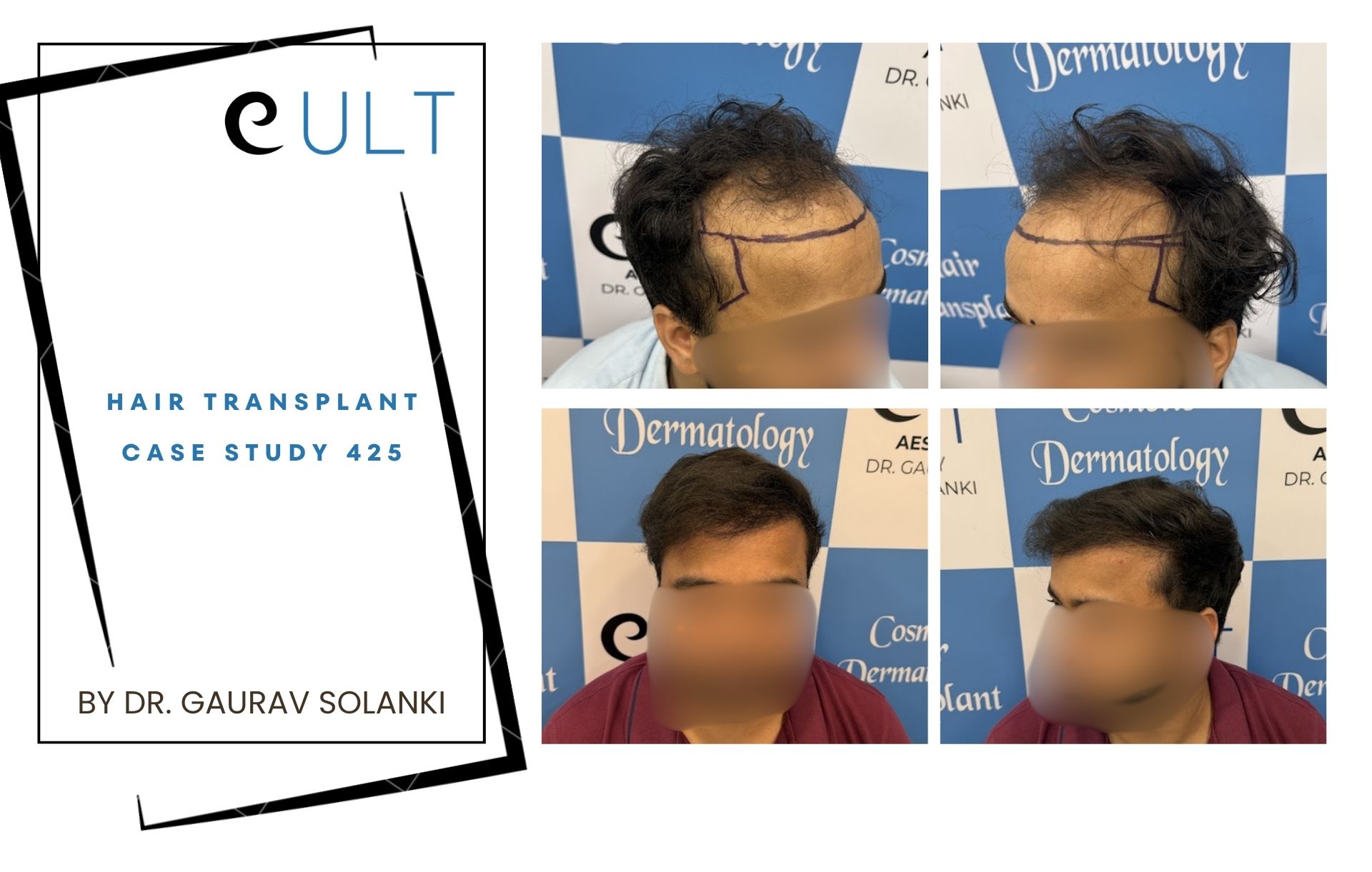 Hair Transplant case 425 Hair Transplant case 421
