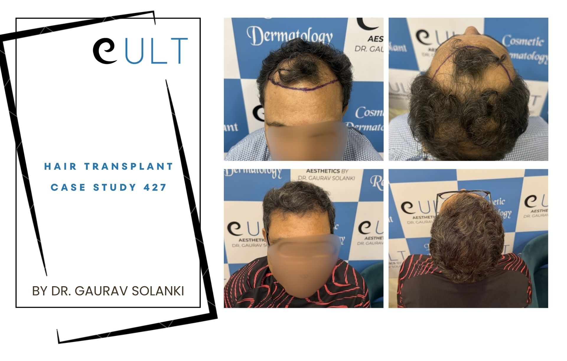 Hair Transplant case 427 Hair Transplant case 421