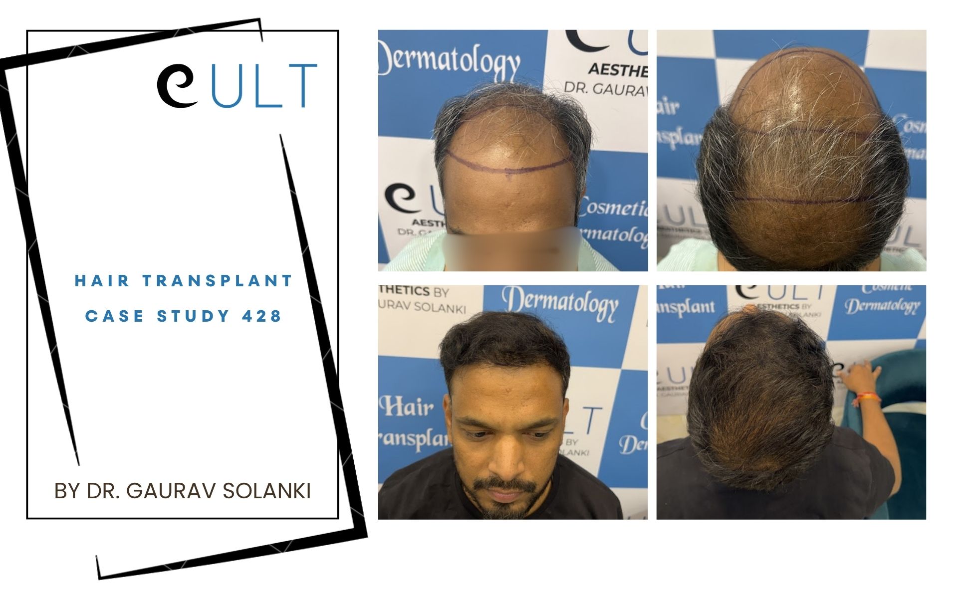 Hair Transplant case 428 Hair Transplant case 420