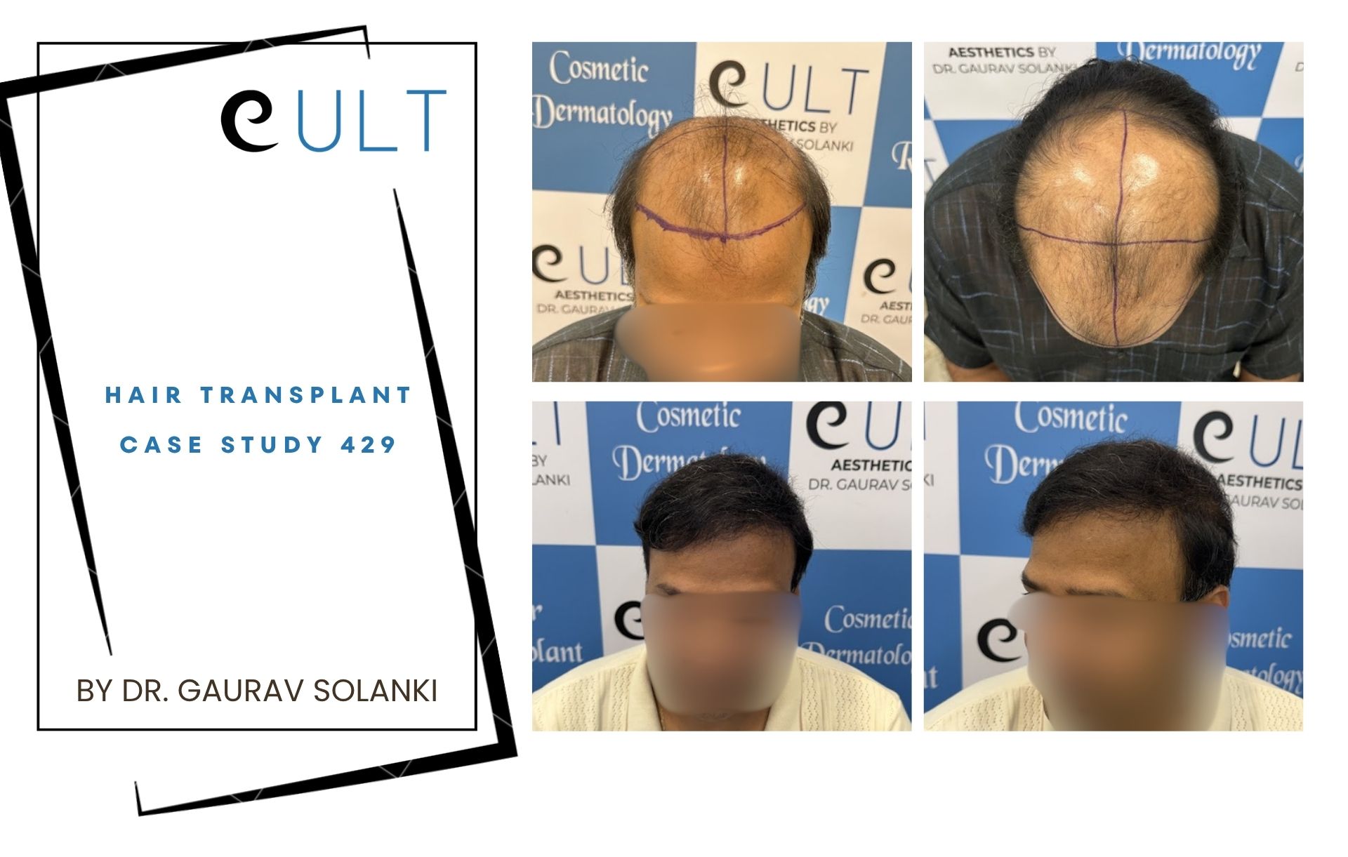 Hair Transplant case 429 Hair Transplant case 421