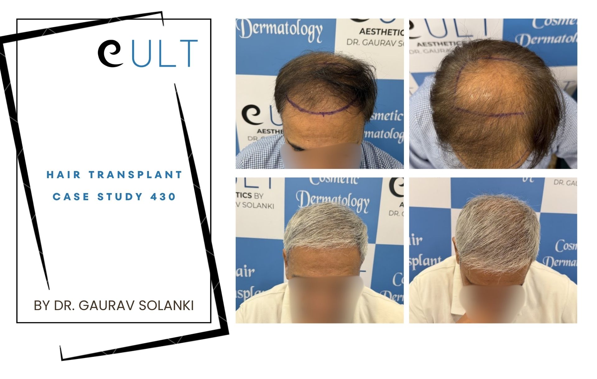 Hair Transplant case 430 Hair Transplant case 420
