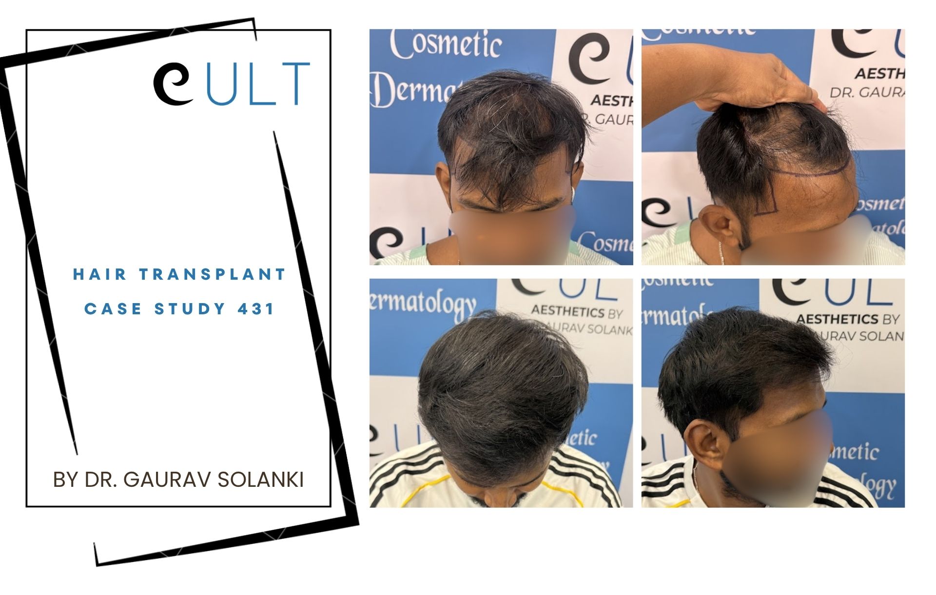Hair Transplant case 431 Hair Transplant case 421