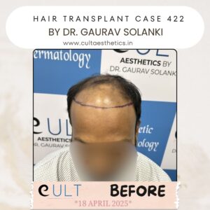 Hair Transplant Case 422 - Before Treatment at Cult Aesthetics Gurgaon