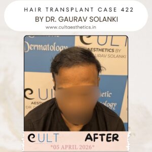 Hair Transplant Case 422 - After Results at Cult Aesthetics Gurgaon