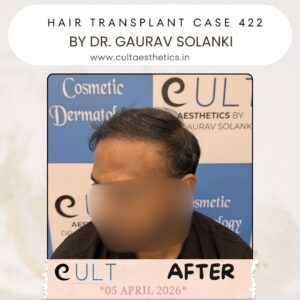 Hair Transplant Case 422 - After Results at Cult Aesthetics Gurgaon