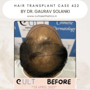 Hair Transplant Case 422 - Before Treatment at Cult Aesthetics Gurgaon