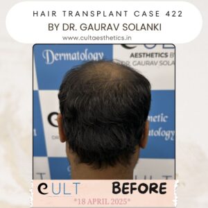 Hair Transplant Case 422 - Before Treatment at Cult Aesthetics Gurgaon