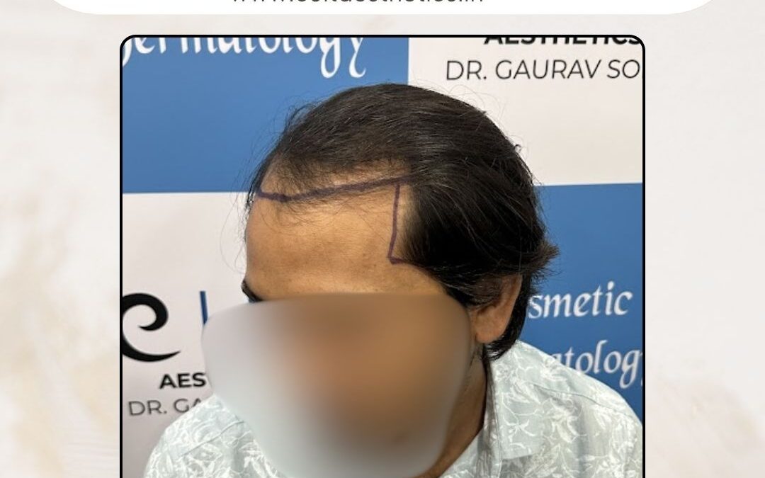 Hair Case 423 Before 3