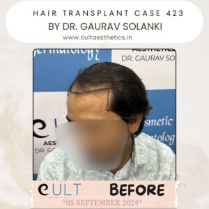 Hair Transplant Case 423 - Before Treatment at Cult Aesthetics Gurgaon