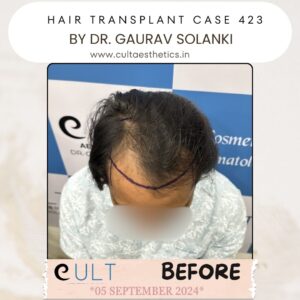 Hair Transplant Case 423 - Before Treatment at Cult Aesthetics Gurgaon