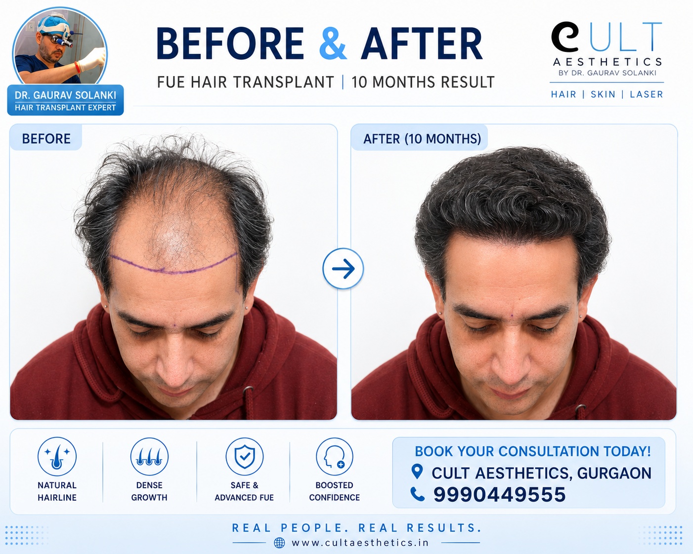 Australian patient before and after FUE hair transplant at Cult Aesthetics Gurgaon showing natural hairline restoration and dense growth at 10 months by Dr. Gaurav Solanki