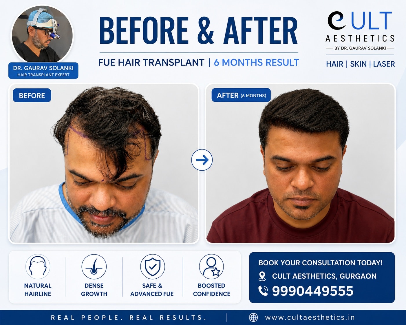 Before and after hair transplant: left image shows thinning hair; right image shows fuller hair after six months, with clinic branding.