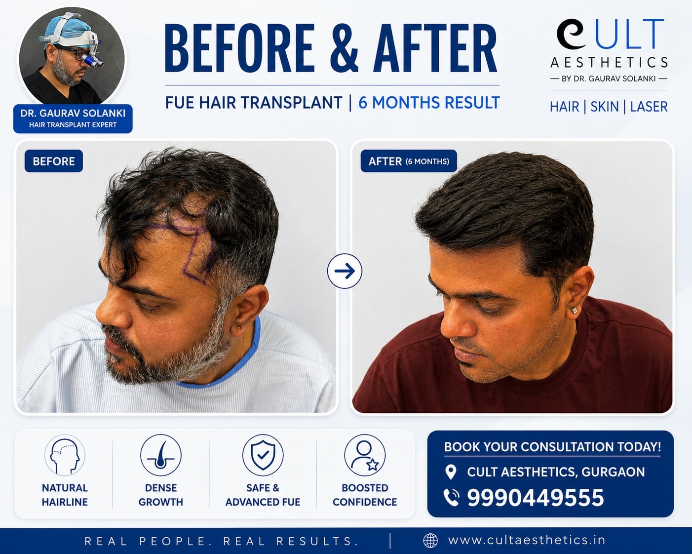 Before-and-after photo of a man's hair transplant: left shows thinning hair and receded hairline, right shows fuller hair after 6 months.
