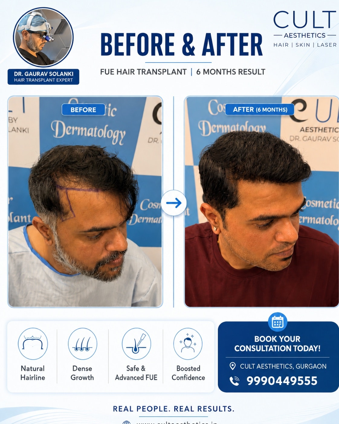 Before & After: photo collage showing a man with hair loss before treatment and fuller hair after 6 months post-FUE hair transplant.