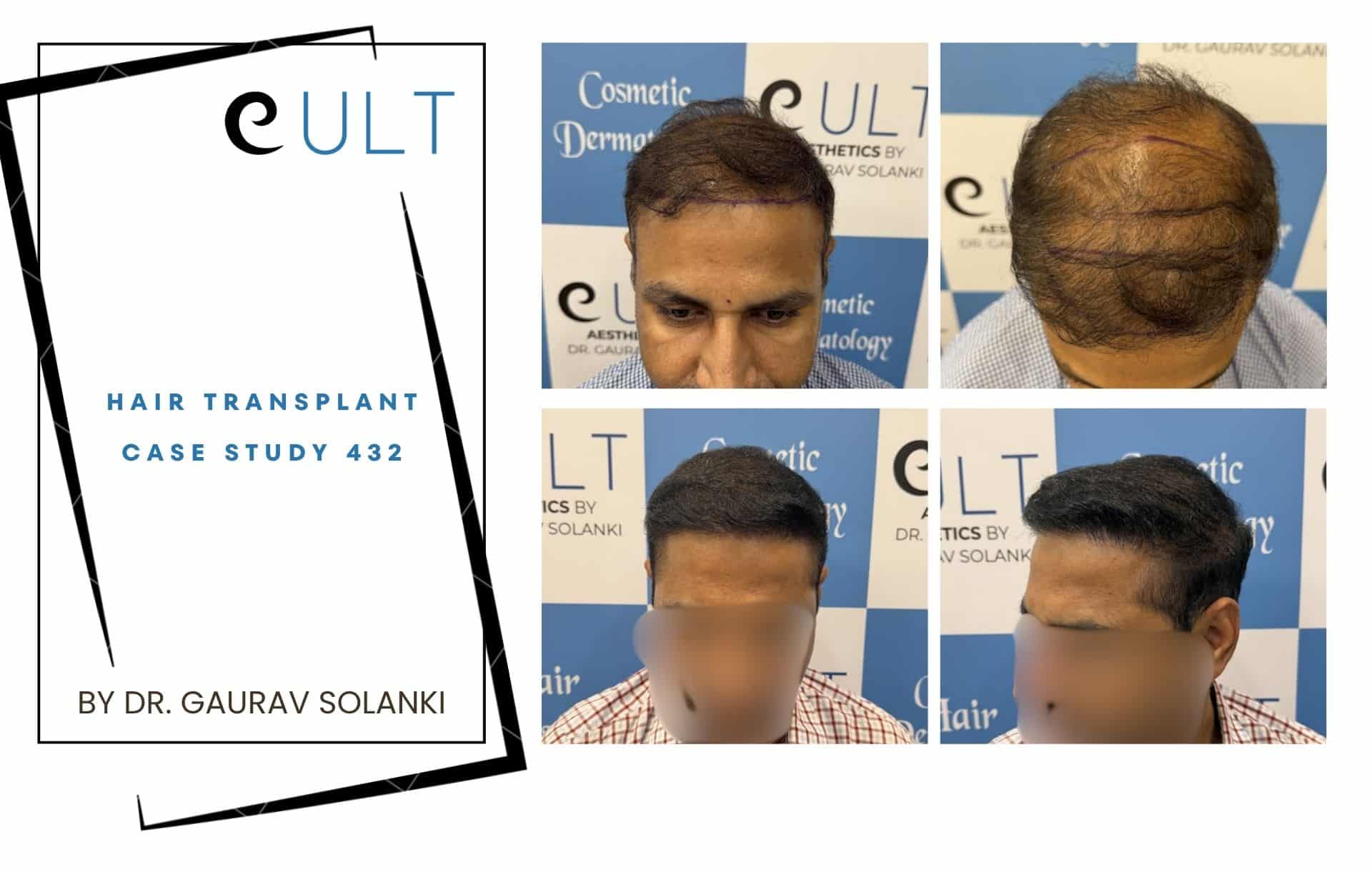 Hair Transplant case 301