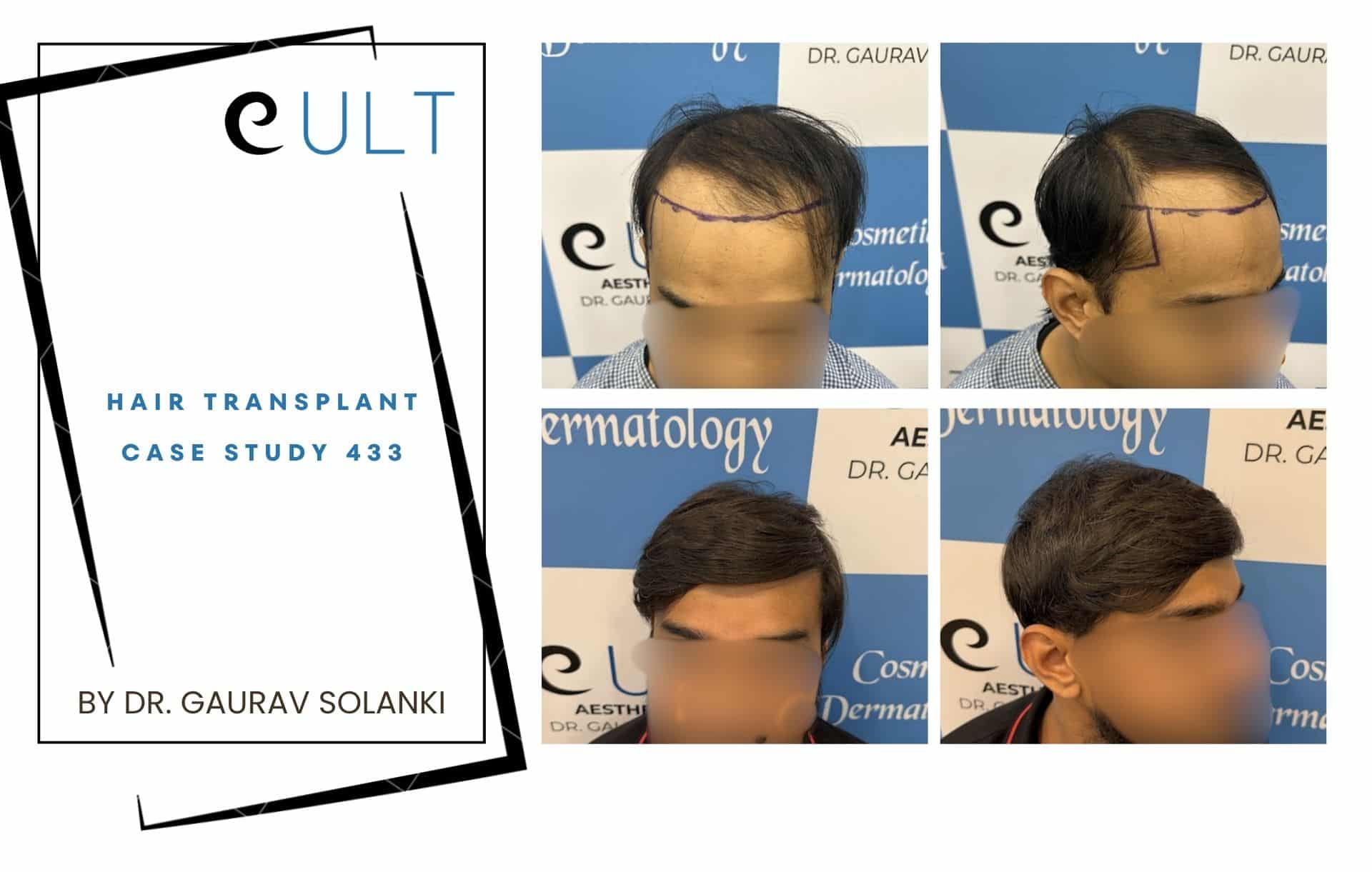 Hair Transplant case 433 | Cult Aesthetics Cover slide: 'Hair Transplant Case Study 433' by Dr. Gaurav Solanki with graphic frame design on left side of the image.