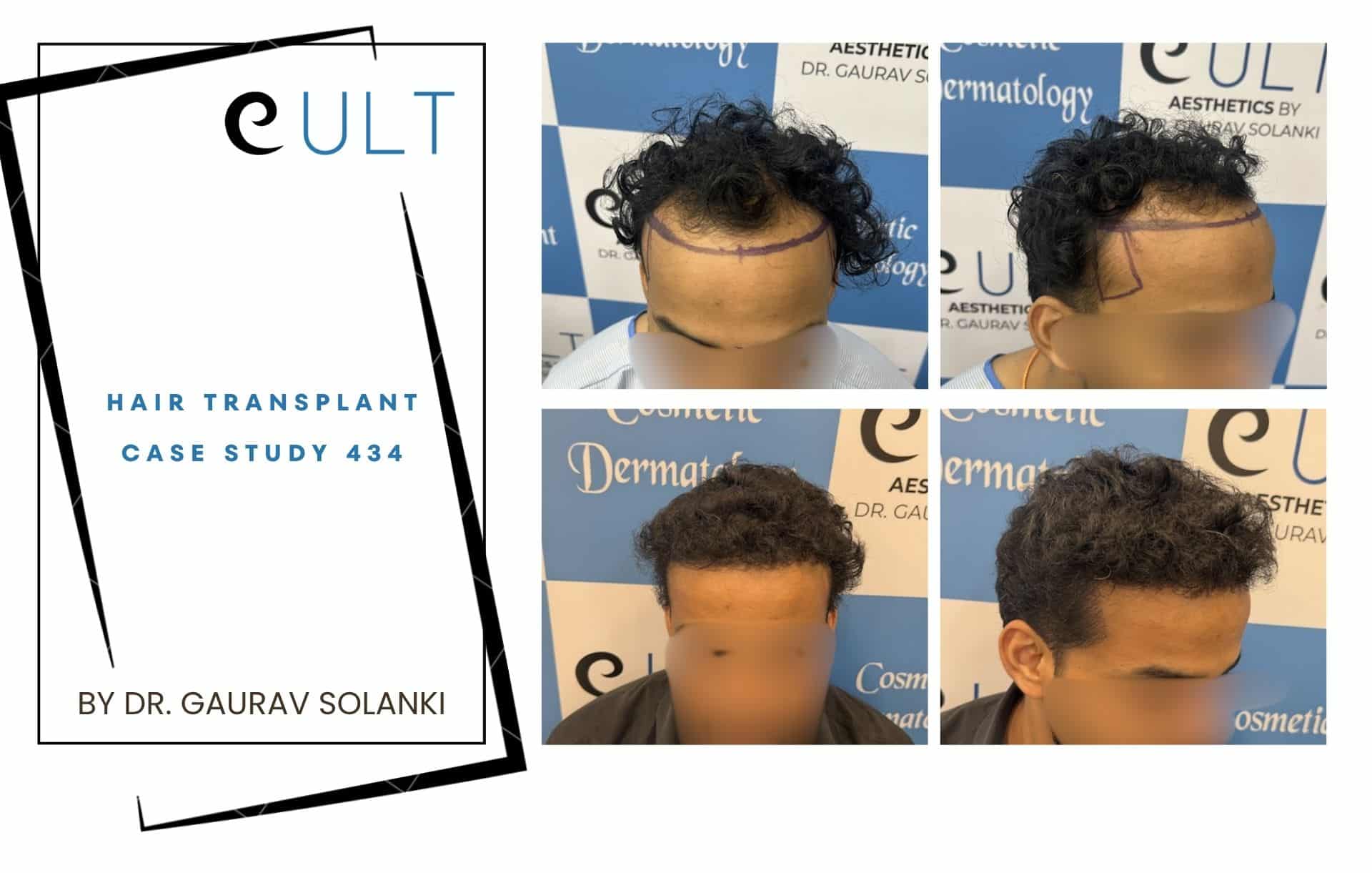 Hair Transplant case 301