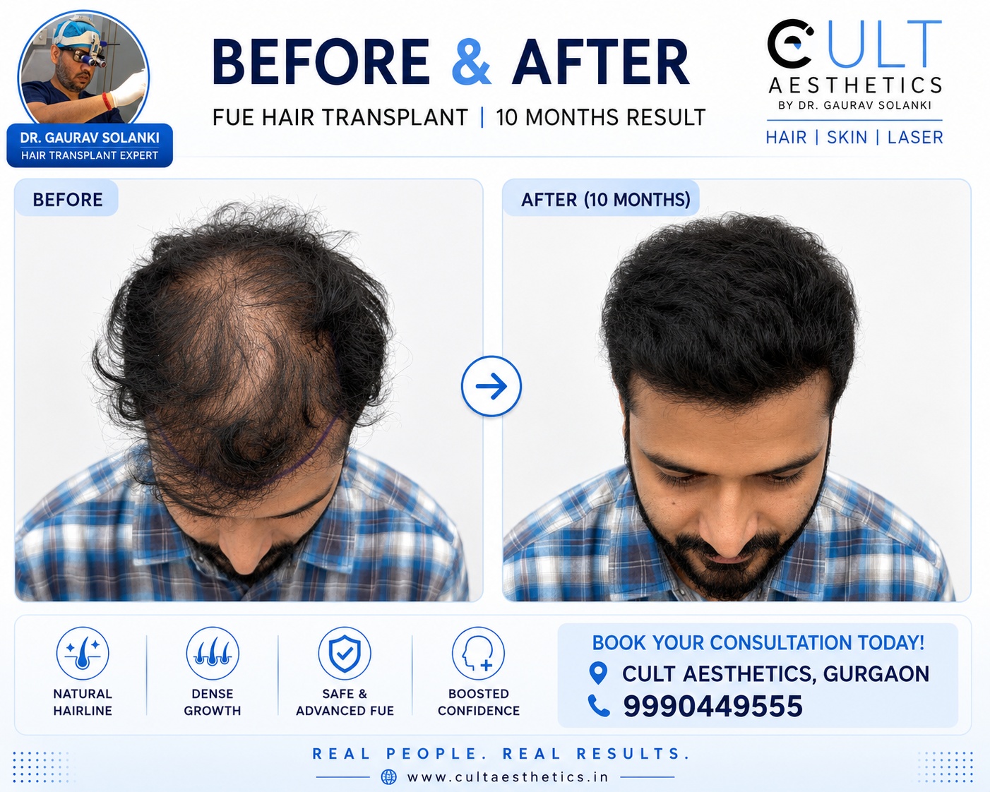 Top-angle before and after FUE hair transplant transformation of an Australian patient at Cult Aesthetics India showing significant crown coverage, dense growth and natural scalp restoration