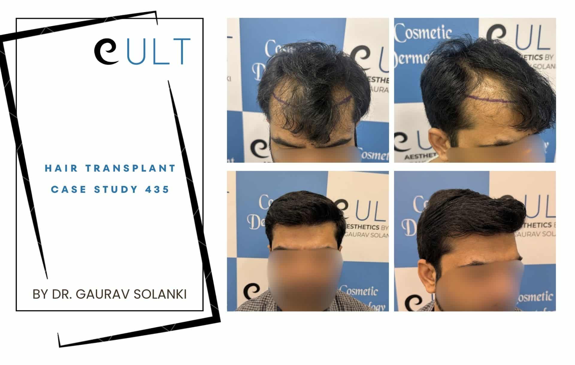 Collage showing a hair transplant case study: left panel with logo and text, right panels a man's before/after transplant photos with new hairline.