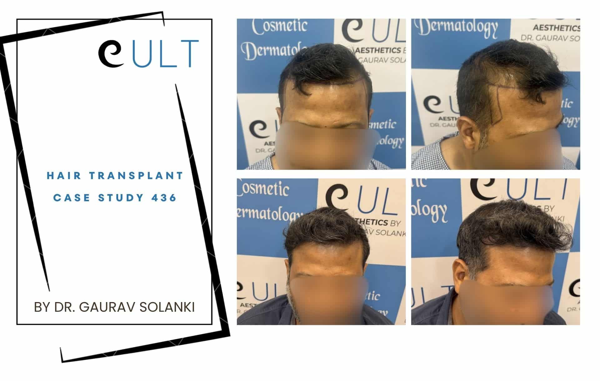 Cover image for 'eULT Hair Transplant Case Study 436' by Dr. Gaurav Solanki, with a collage showing hair transplant progress photos.