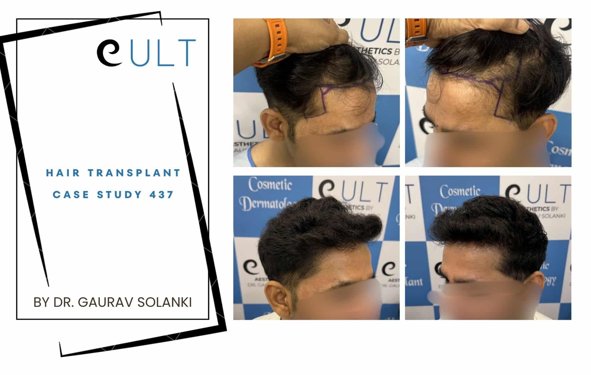 Hair Transplant case 301