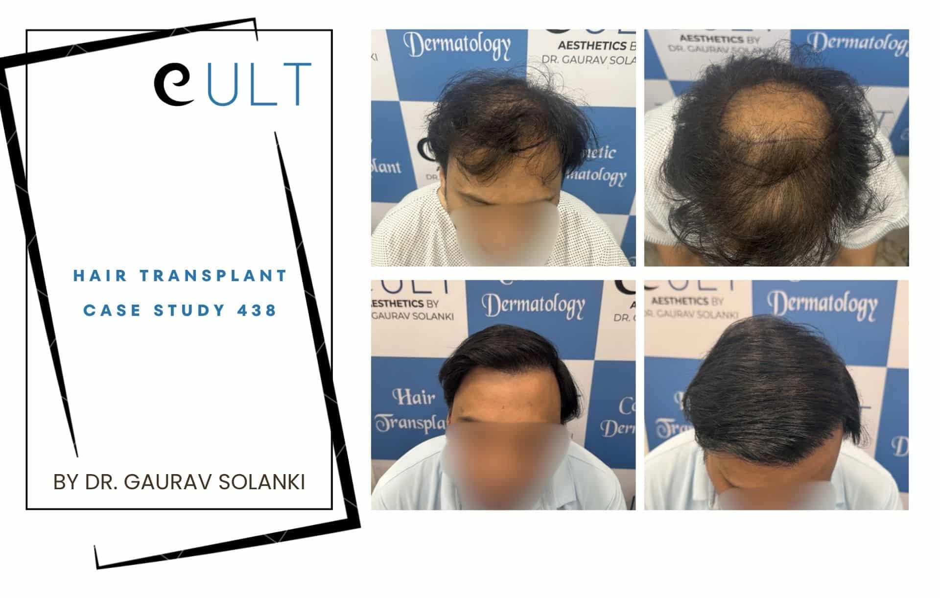 Left: a brochure cover reading 'CULT Hair Transplant Case Study 438' by Dr. Gaurav Solanki; right: grid of six photos showing a man's scalp with varying hair density, illustrating hair transplant progress.