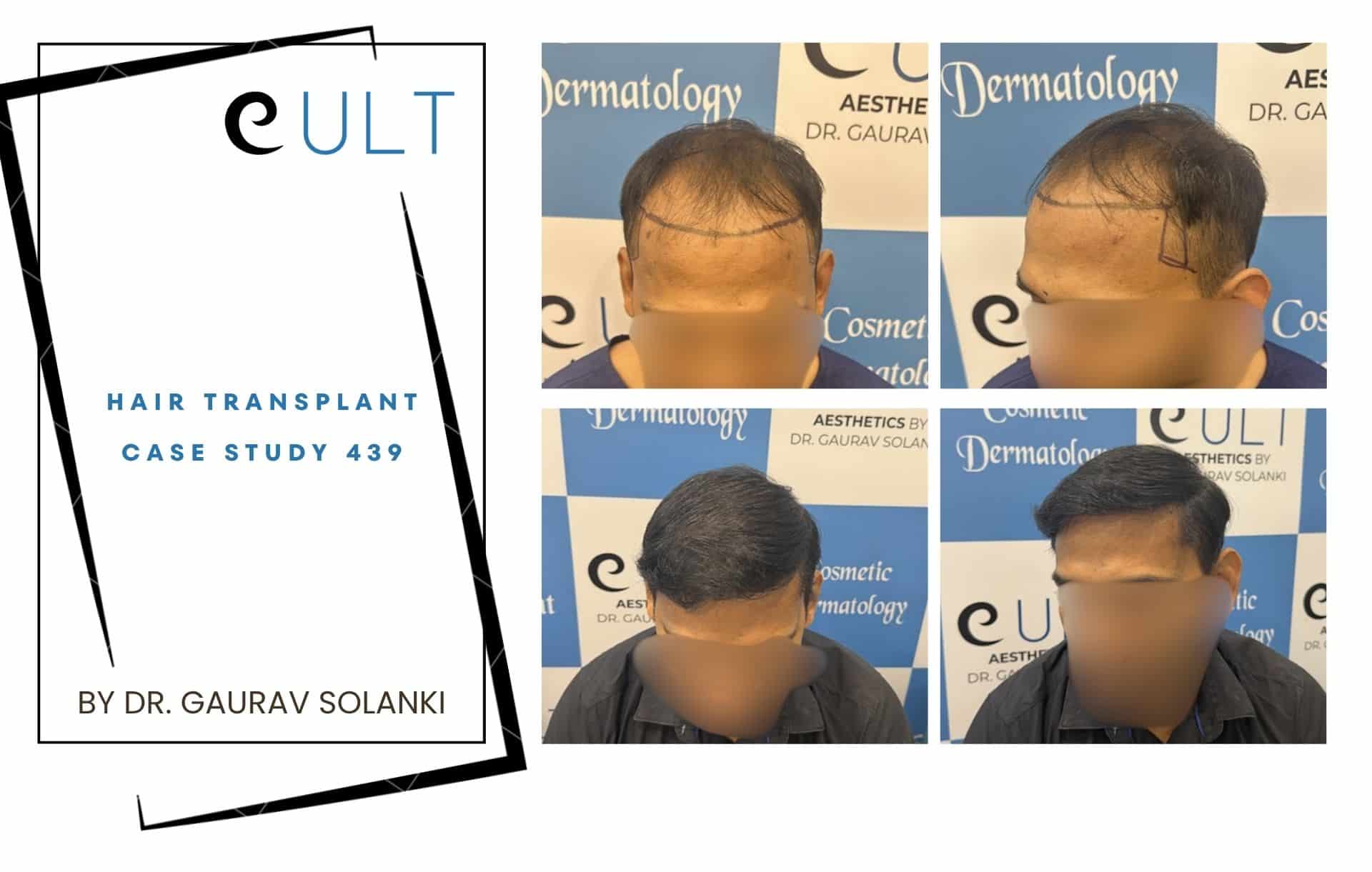 Hair Transplant case 301