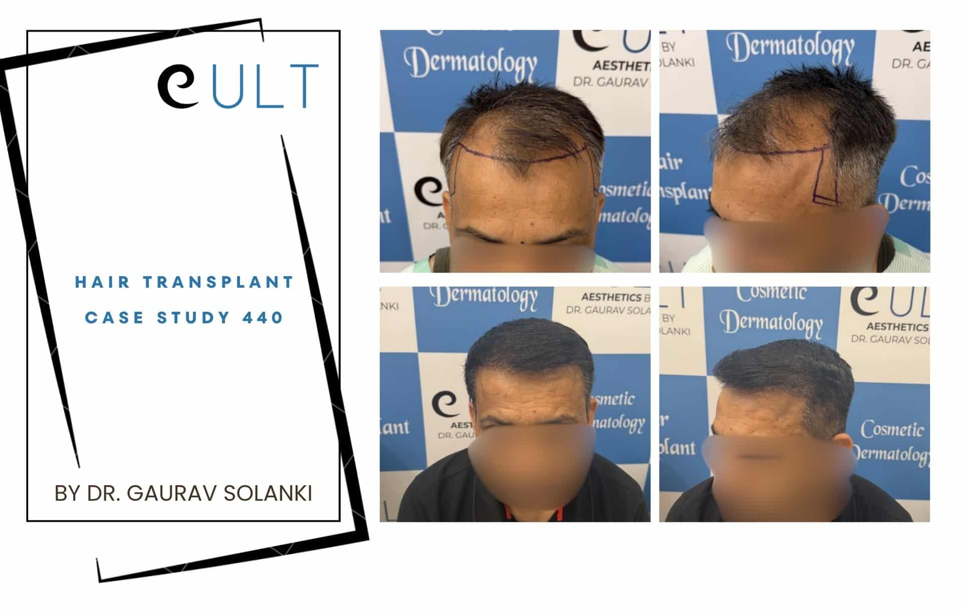 Cover page of a hair transplant case study by Dr. Gaurav Solanki, with a collage of before/after photos and graphic elements.