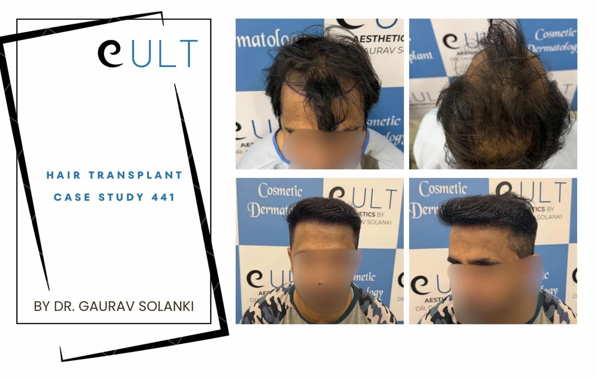 Case-study cover page: 'Hair Transplant Case Study 441' by Dr. Gaurav Solanki on white background with black geometric frames