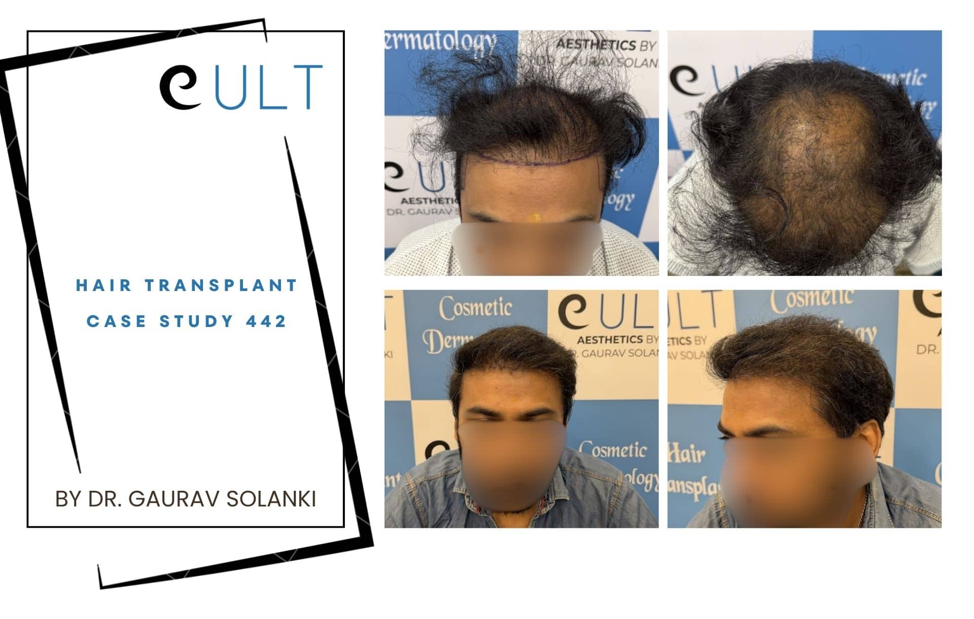 Left panel: cover page for 'eULT Hair Transplant Case Study 442' by Dr. Gaurav Solanki.