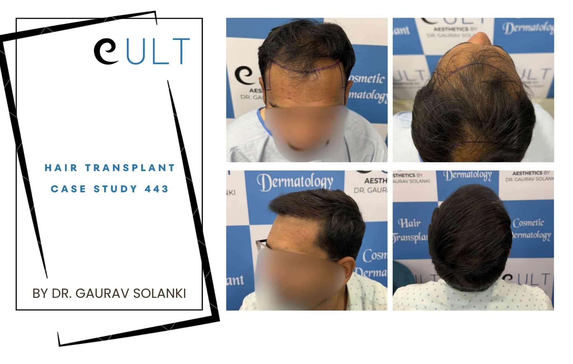 Collage: a hair transplant case study cover on the left and four photos of a man's scalp on the right, showing before/after results.